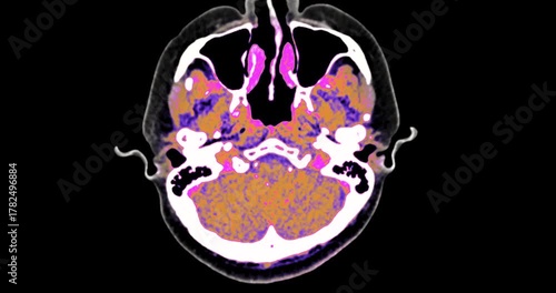 CT angiography of the brain in axial view demonstrates enhanced cerebral vessels. Advanced radiology imaging for diagnosis of vascular disease, stroke, or aneurysm.