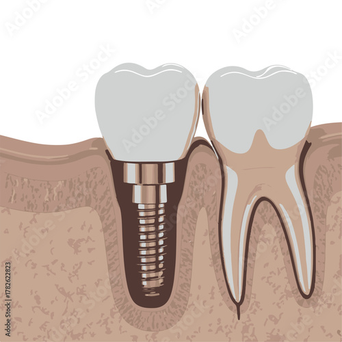 Dental Implant and Natural Tooth Cross- Section crown