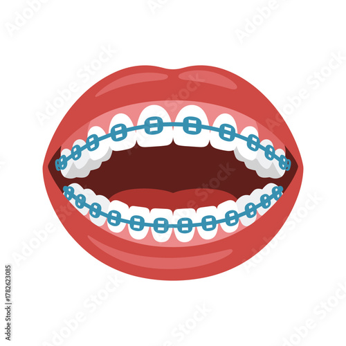 Open mouth with white teeth and blue orthodontic braces on a white background.