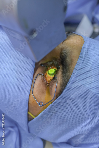 closeup photo of collagen cross linking operation for treating keratoconus