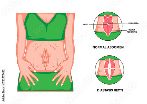 Diastasis Recti and Six-Pack Muscle Separation in the Female Abdomen