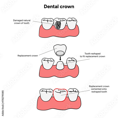 Hand-drawn dental infographic of tooth crown detailed educational illustration. Dental clinics, anatomy books, medical guides, and oral health posters. Ideal for educational materials