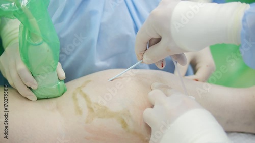 Endovenous laser ablation procedure on patient leg