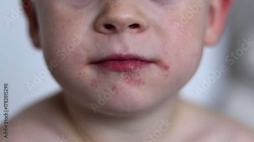 Boys face with red rash infection around his mouth, blurred background 