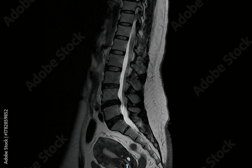 Sagittal lumbar spine MRI showing vertebrae, intervertebral discs, spinal canal, and spinal cord anatomy. Medical diagnostic imaging for disc herniation evaluation, spinal stenosis detection.