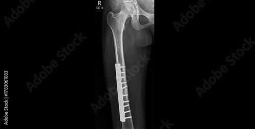 Hip X-ray radiograph showing femur fracture with surgical plate and screws fixation. Medical imaging for post-operative assessment of hip and femoral shaft repair, orthopedic hardware placement.