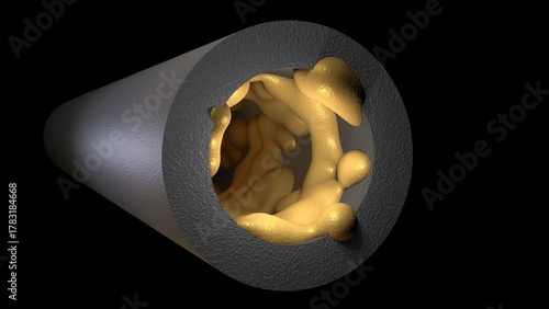 Biofilm accumulation inside tube. Clog in pipe. Atherosclerosis. Arterial blockage with plaque, cholesterol, debris buildup. 3d render illustration. 