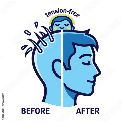 Before and After Hair Transplant - Successful Hair Restoration