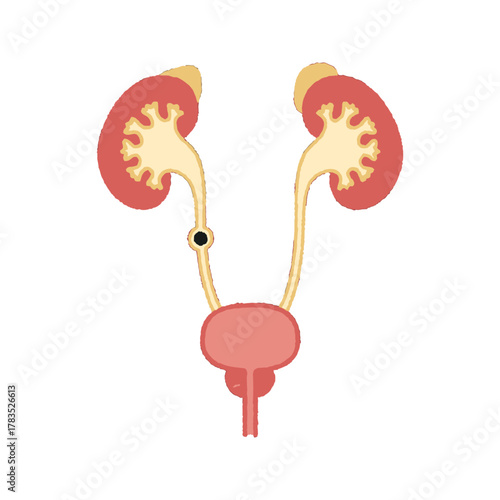 Kidney stone in ureter human urinary system illustration.