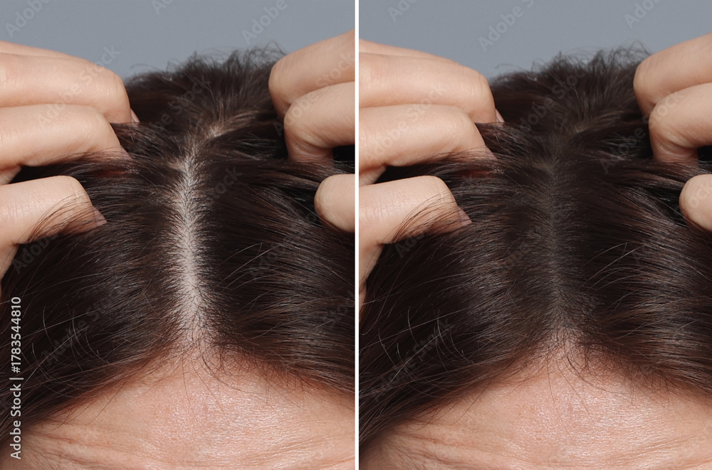 Obraz premium Woman with hair loss problem before and after therapy, closeup. Collage on grey background