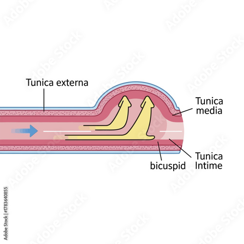 Detailed illustration of a bicuspid valve within a blood vessel structure.