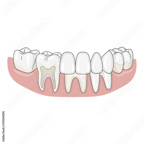 Detailed illustration of a fixed dental bridge prosthesis on gums.