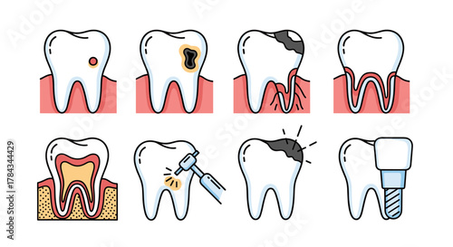 Set of modern outline style icons illustrating dental caries progression and treatment, including cavities, root decay, drilling, and dental implants, presented on a clean white background for