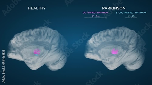 Parkinson Dopamine Loss Basal Ganglia Motor Circuit Comparison Blue Background