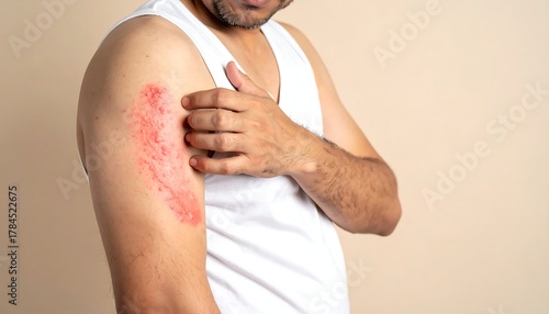 Red inflamed itchy skin patch on arm, medical condition, plain background