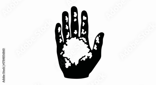 Vitiligo skin condition icon. Black and white vector illustration of a hand with depigmentation. Dermatology and skin diversity symbol