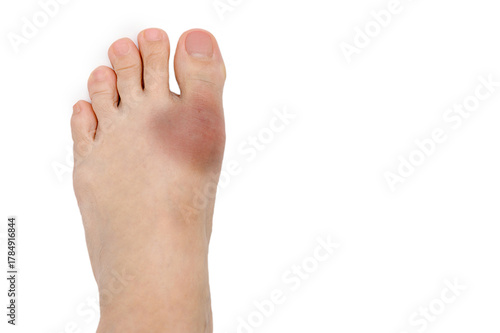 Blue bruise on the foot on a white background.