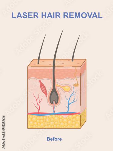 Cross-section diagram of human skin with visible hair follicles and internal structures on a light background, concept of laser hair removal process. Vector illustration