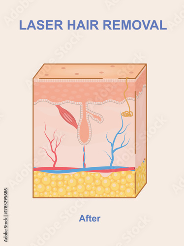 Cross-section of human skin showing the result after laser hair removal, in a clean and colorful medical graphic style on a light background. Vector illustration