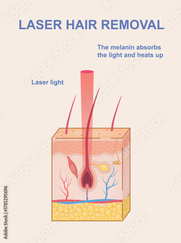 Cross-section of human skin showing hair follicle treated with laser light, flat style on light background. Concept of laser hair removal treatment. Vector illustration