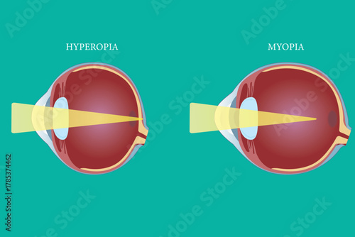 Medical illustration comparing hyperopia and myopia focusing differences in the human eye. eps 10