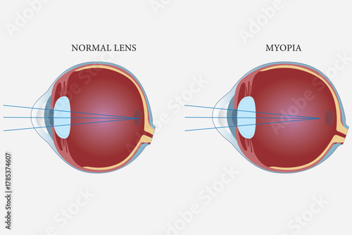 Medical illustration comparing normal vision and myopia focus in the human eye. eps 10