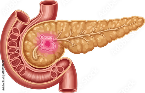 Illustration of Pancreatic Cancer, Highlighting the Pancreas and Surrounding Duodenum