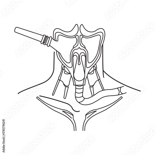 Intubation Procedure Illustration Medical Diagram Upper Airway Larynx Trachea Nasopharynx Anatomy Healthcare Medical
