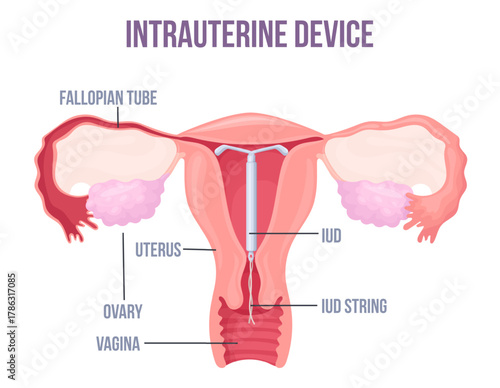 Lud. Intrauterine device placement in uterus, female contraception birth control copper or hormonal coil mirena iucd medical education preventive pregnancy neat vector illustration