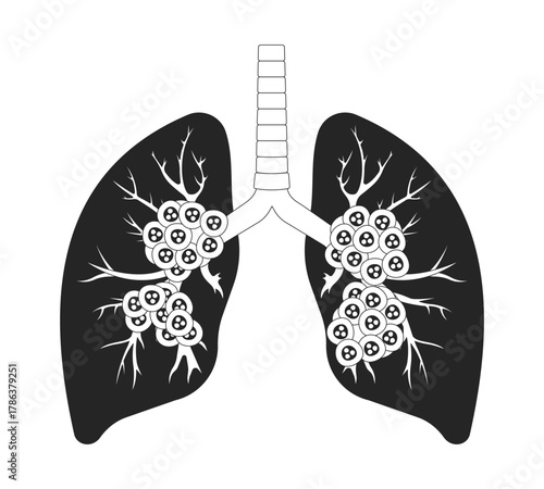 Human lungs affected by late-stage cancer outline illustration. Malignant cells. Alveoli oncology. Tumor in branching bronchi 2D line object isolated on white. Monochrome vector ink linear image