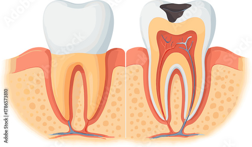 Healthy vs Decayed Tooth Cross Section – Dental Caries Comparison Illustration