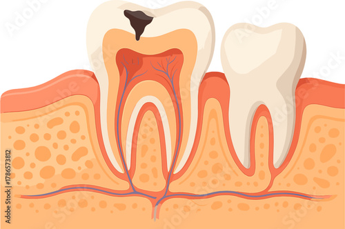 Tooth Decay Cross Section – Dental Caries and Root Structure Illustration