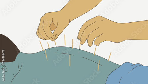 A closeup view of a practitioner applying acupuncture needles on a clients back highlighting the precision and relaxation involved in the process.