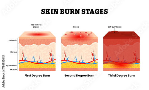 Stages of skin burn stage, first, second and third degree burn. Wound after burn. Types of injury to skin. Human skin layers anatomy cross section. Vector illustration.