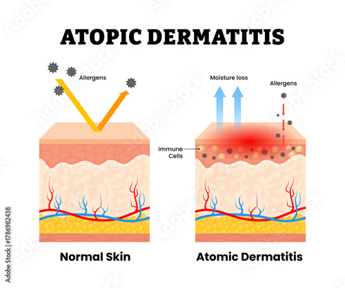 Atopic dermatitis or atopic eczema skin with normal skin structure anatomy cross section. Dry skin inflammation. Filaggrin. Immune cells, moisture loss, allergens. Vector illustration.