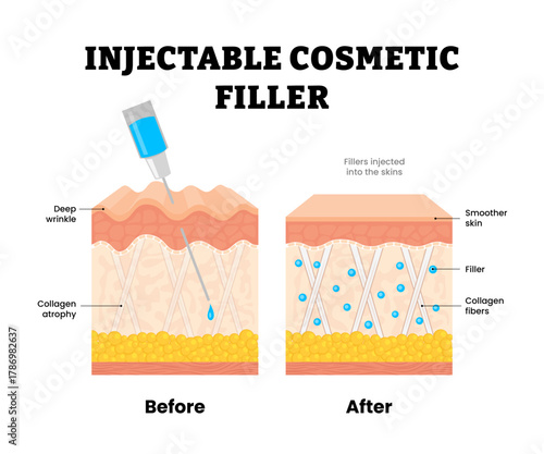 Before after injectable cosmetic filler procedure injection. Beauty treatment, Collagen atrophy and Deep wrinkle, smoother skin. Human skin layers anatomy cross section. Vector illustration.
