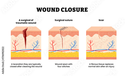Before after wound closure steps from surgical or traumatic wound to suture and scar. Wound sewn, fibrous tissue replace after injury. Human skin layers anatomy cross section. Vector illustration.