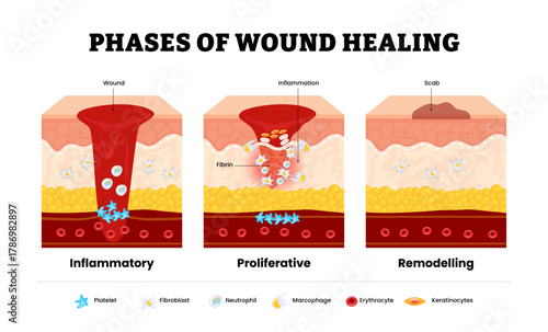 Wound healing process. Stages of the post-trauma repairing process. Inflammatory, proliferation or inflammation, remodeling phase. Skin structure layer human skin cross section. Vector illustration