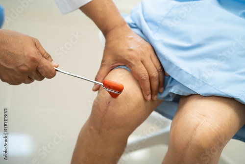 Φωτογραφία Doctor neurologist testing reflex knee with hammer and show Asian senior scars surgical total knee joint replacement