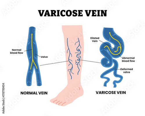 Varicose vein with dilated vein, abnormal blood flow and deformed valve. Cramps Limb Injury Phlebectomy of Vascular Artery Disease. Varicose vein structure diagram. Vector illustration