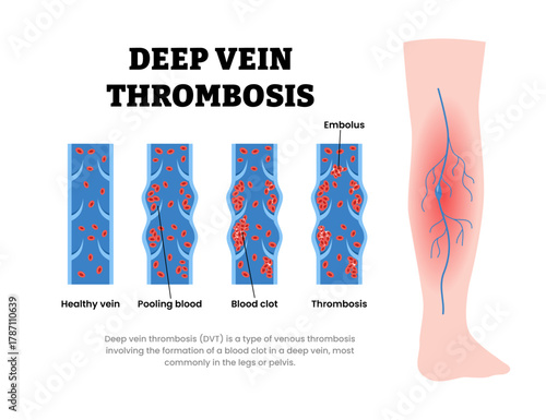 Types of deep vein thrombosis type with normal vein, pooling blood, blood clot, thrombosis, embolus. with leg diagram. Dangerous red blood cells flow. Cardiovascular disease. Vector illustration.