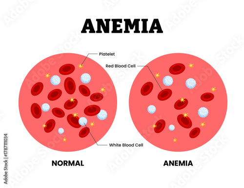 Anemia vs normal blood specimen blood composition comparison. Human blood cells structure. Thrombocytes, leukocytes, erythrocytes under microscope. Microbiology test. Blood disorder.