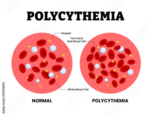 Polycythemia vs normal blood specimen blood composition comparison. Human blood cells structure. Thrombocytes, leukocytes, erythrocytes under microscope. Microbiology test. Blood disorder.