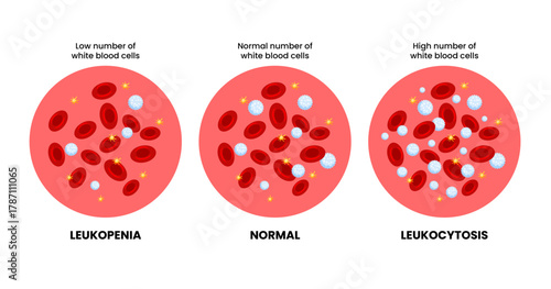 Leukopenia, normal blood vs Leukocytosis specimen blood composition comparison. Human blood cells structure. Thrombocytes, leukocytes, erythrocytes under microscope. Microbiology test. Blood disorder