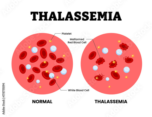 Thalassemia vs normal blood specimen blood composition comparison. Human blood cells structure. Thrombocytes, leukocytes, erythrocytes under microscope. Microbiology test. Blood disorder.