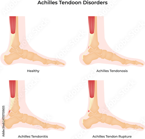 Achilles Tendon Disorders Healthy Tendonosis Tendonitis Rupture Comparison Vector Illustration