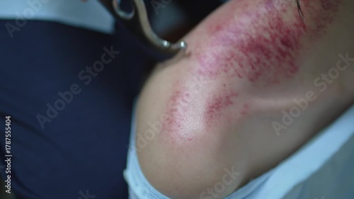 Therapist doing skin scrape technique. concept of chinese technique, gua sha, for pain relief and treatment and activating blood circulation. Stimulus therapy.
