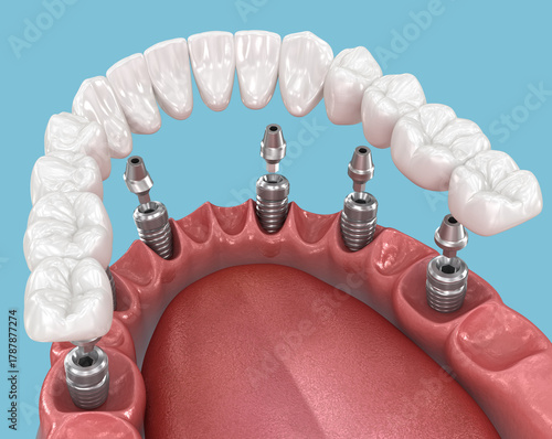 Mandibular prosthesis with gum supported by 6 implants. 3D illustration of human teeth and dentures concept