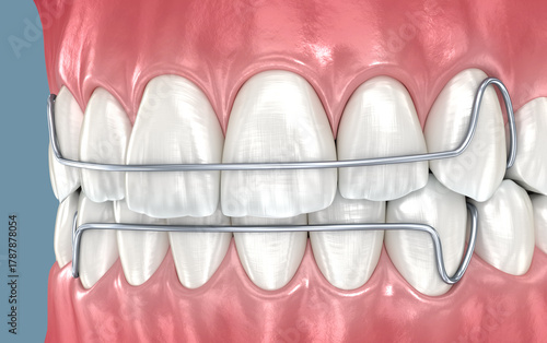 Dental retainers installed after braces treatment, 3D illustration
