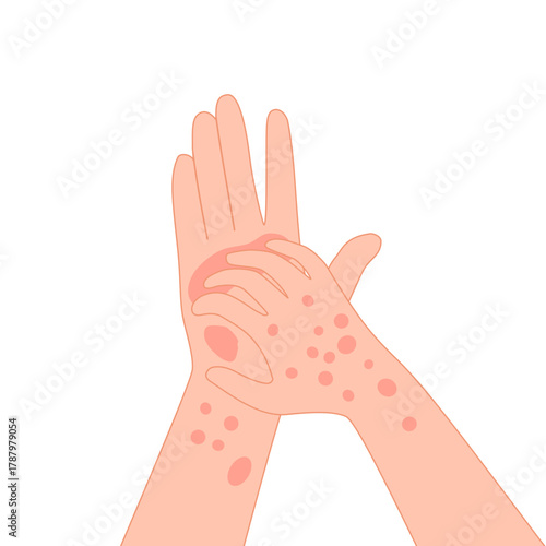 Rash skin on hand. Rashes itching hands scratch arm in red spot, dermatitis allergy symptoms itchy hives medicine pele virus eczema urticaria irritation disease vector illustration of skin disease
